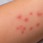 Close-up of bed bug bites on a person's arm showing a cluster of red, itchy bite marks.