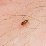 a little flea bites on a human